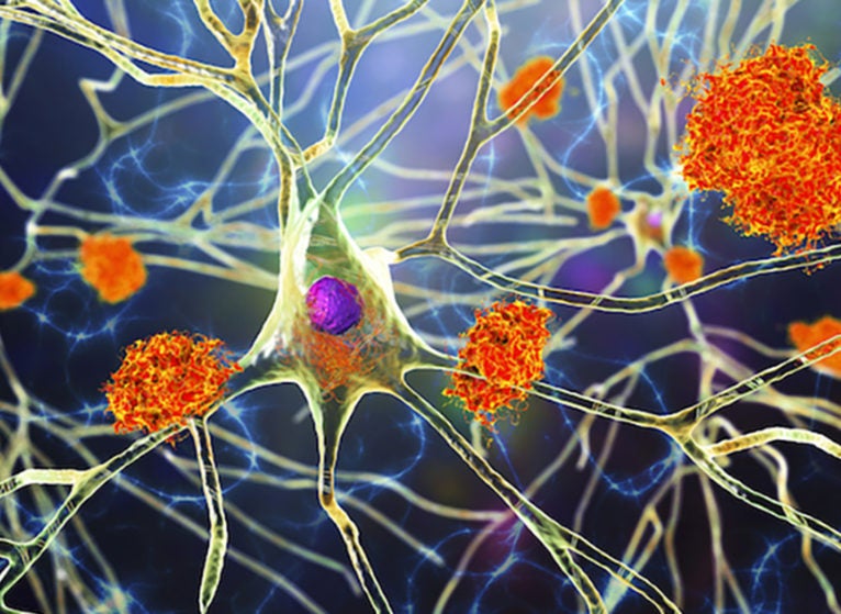 Alzheimer's disease. Illustration of amyloid plaques amongst neurons and neurofibrillary tangles inside neurons. Amyloid plaques are characteristic features of Alzheimer's disease. They lead to degeneration of the affected neurons, which are destroyed