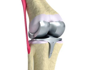 Knee Replacement