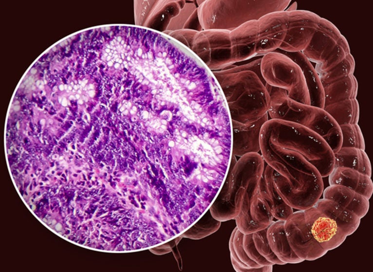 Colon cancer, computer illustration and light micrograph showing colon adenocarcinoma.