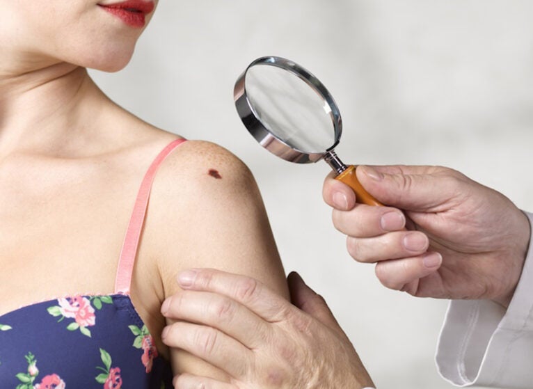 Dermatologist inspecting melanoma