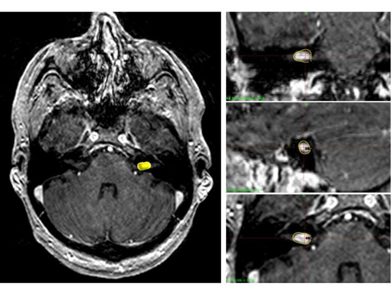 A vestibular schwannoma — a nerve growth that can cause loss of balance and hearing — is shown in yellow.