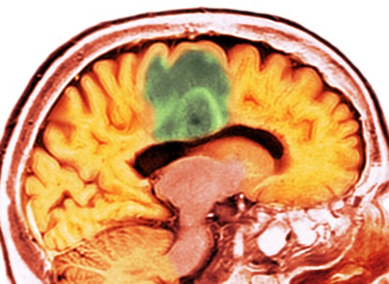 Getty_Glioblastoma brain cancer
