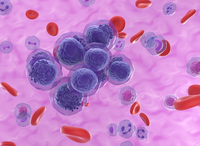 acute myeloid leukemia
