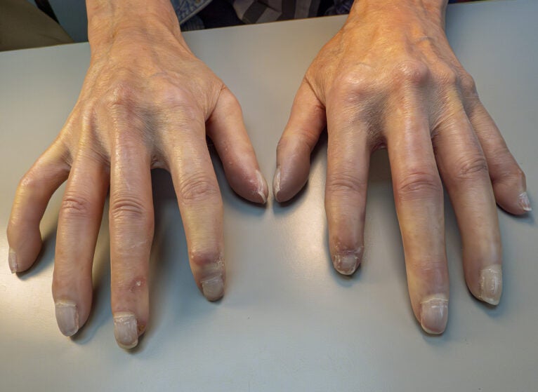 hands-with-scleroderma