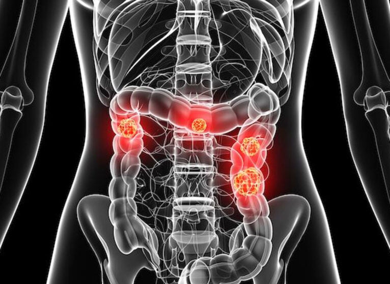 colorectal cancer