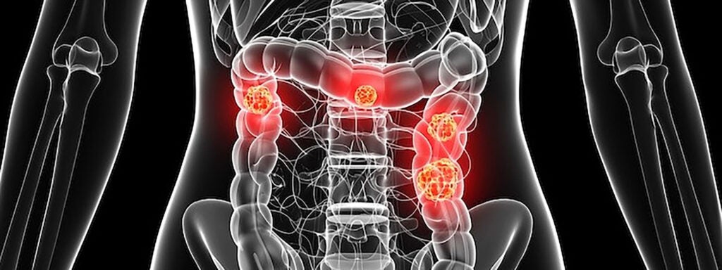 Colorectal Cancer Screening