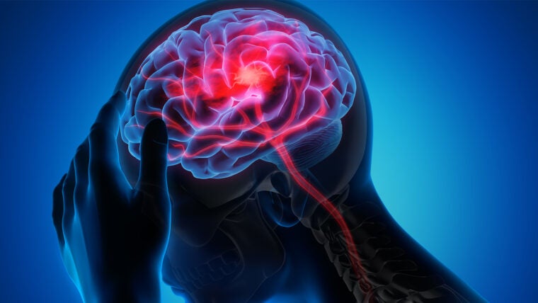 Stroke_Brain_Getty