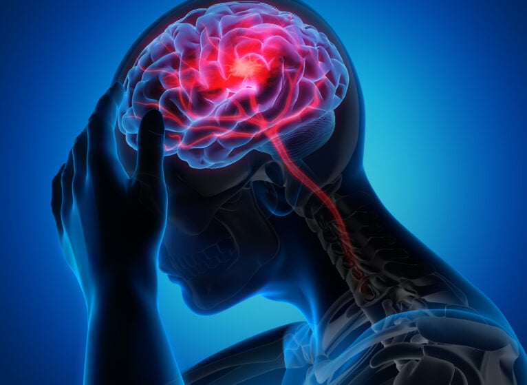 Stroke_Brain_Getty